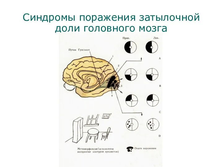 Синдромы поражения затылочной доли головного мозга