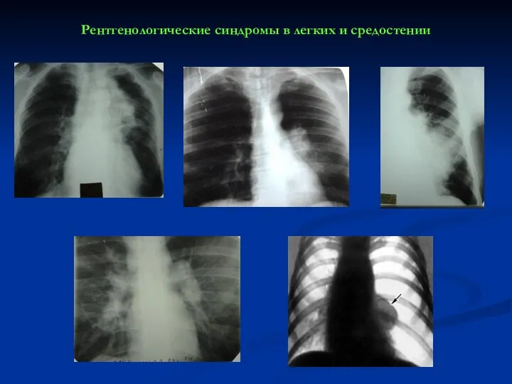 Рентгенологические синдромы в легких и средостении