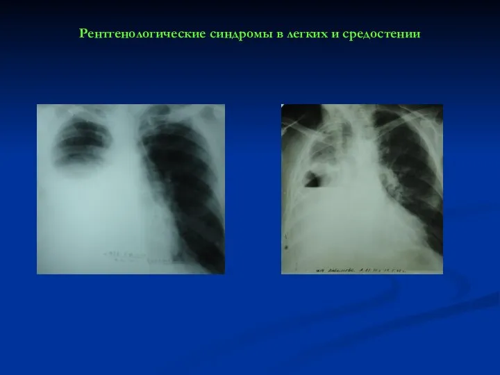 Рентгенологические синдромы в легких и средостении