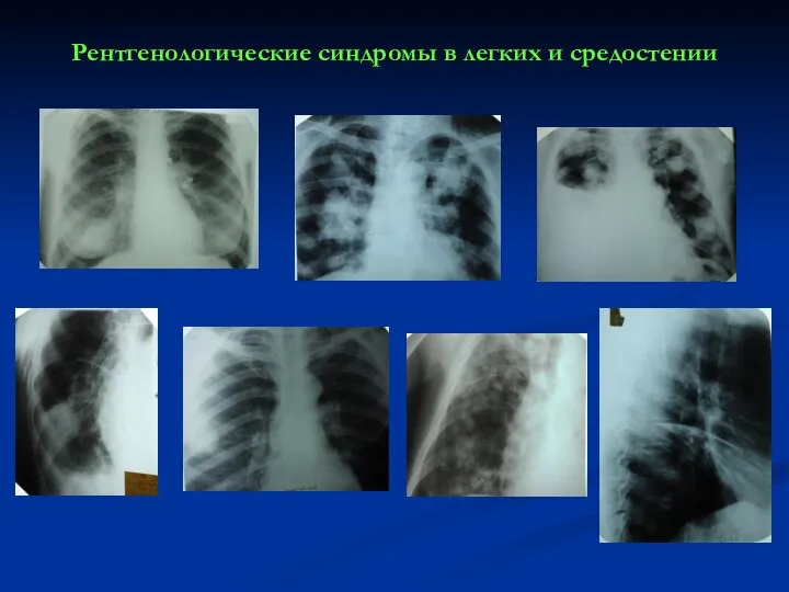 Рентгенологические синдромы в легких и средостении