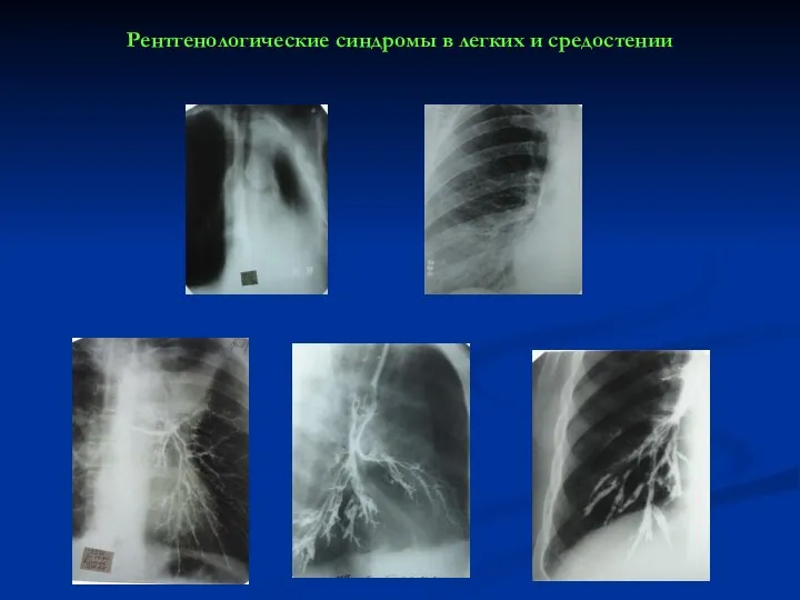 Рентгенологические синдромы в легких и средостении