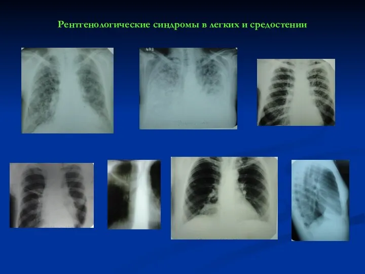 Рентгенологические синдромы в легких и средостении