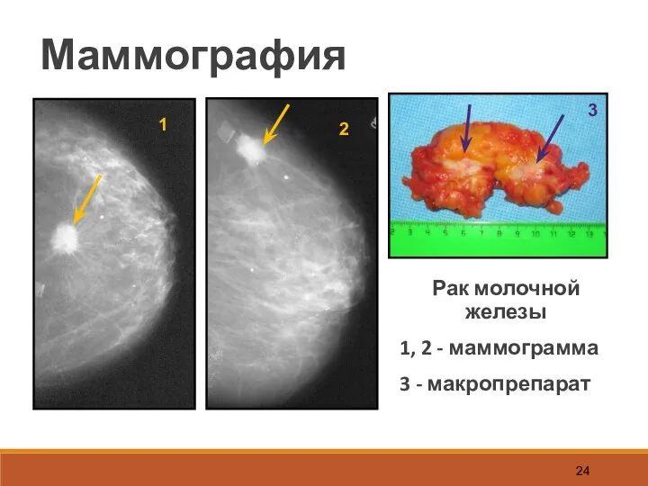Маммография Рак молочной железы 1, 2 - маммограмма 3 - макропрепарат 3