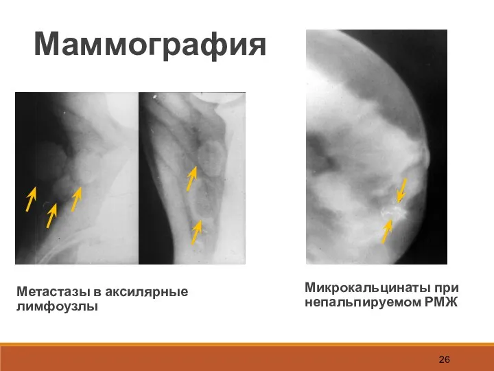 Маммография Микрокальцинаты при непальпируемом РМЖ Метастазы в аксилярные лимфоузлы