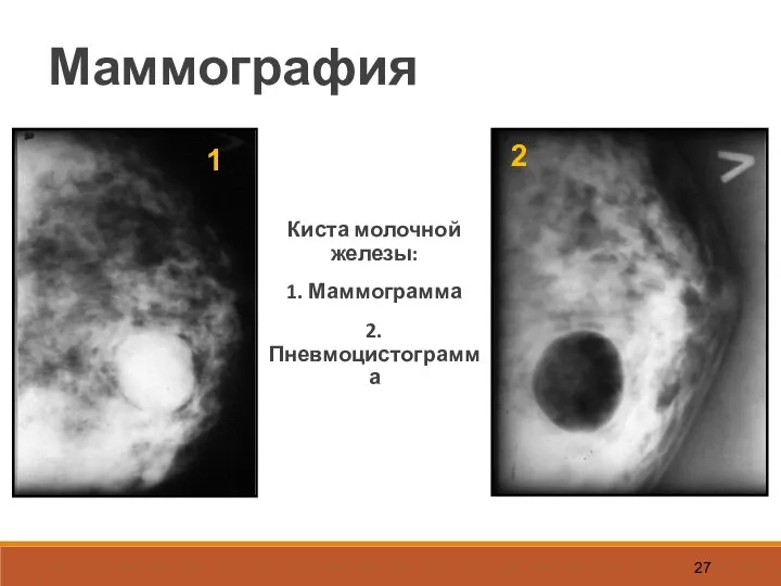 Маммография Киста молочной железы: 1. Маммограмма 2. Пневмоцистограмма