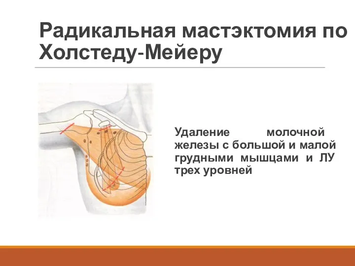 Радикальная мастэктомия по Холстеду-Мейеру Удаление молочной железы с большой и малой