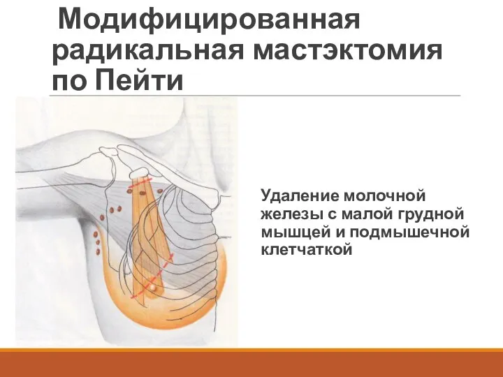 Модифицированная радикальная мастэктомия по Пейти Удаление молочной железы с малой грудной мышцей и подмышечной клетчаткой