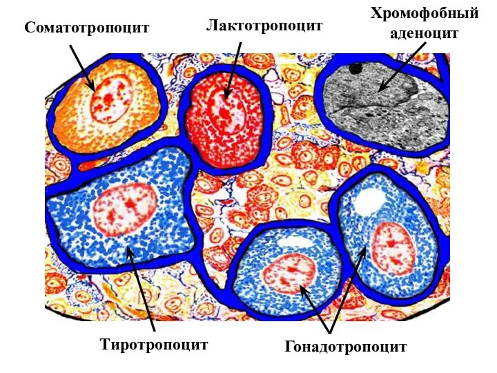 Гонадотропоцит Тиротропоцит Лактотропоцит Соматотропоцит Хромофобный аденоцит