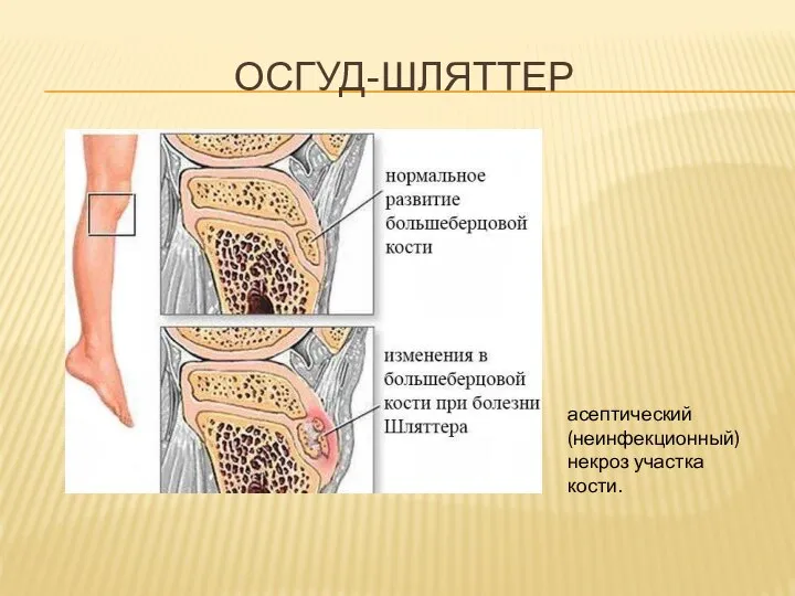 ОСГУД-ШЛЯТТЕР асептический (неинфекционный) некроз участка кости.