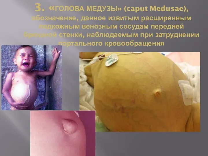 3. «ГОЛОВА МЕДУЗЫ» (caput Medusae), обозначение, данное извитым расширенным подкожным венозным