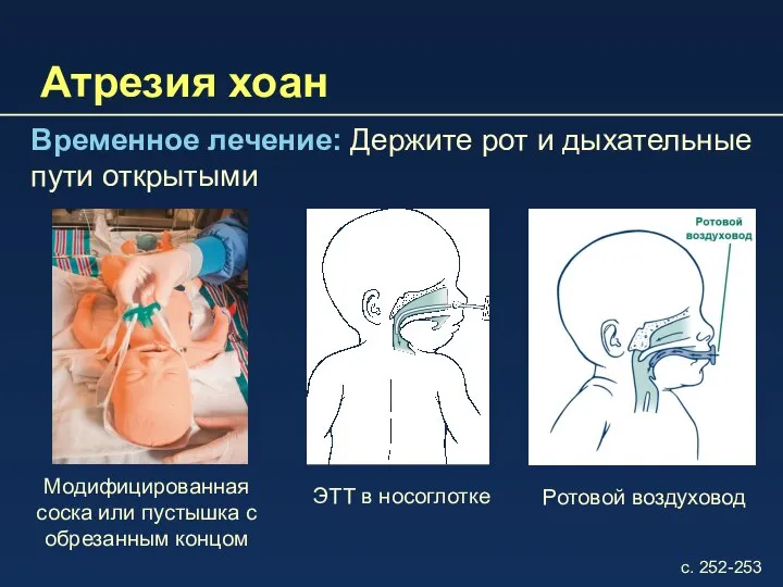 Атрезия хоан Временное лечение: Держите рот и дыхательные пути открытыми Модифицированная