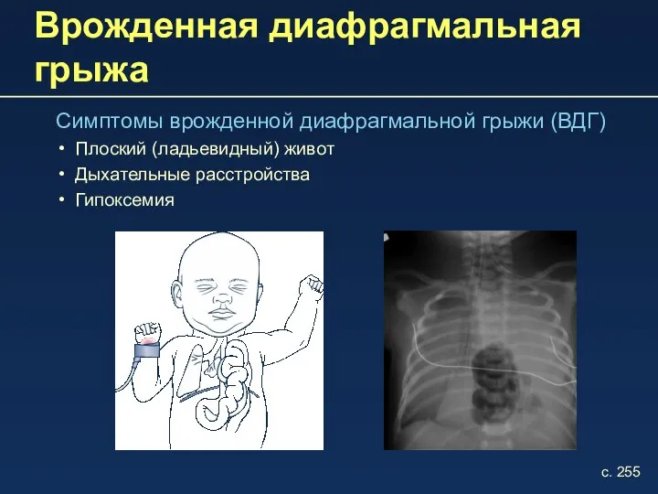 Врожденная диафрагмальная грыжа Симптомы врожденной диафрагмальной грыжи (ВДГ) Плоский (ладьевидный) живот Дыхательные расстройства Гипоксемия с. 255