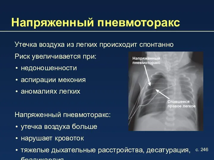 Утечка воздуха из легких происходит спонтанно Риск увеличивается при: недоношенности аспирации