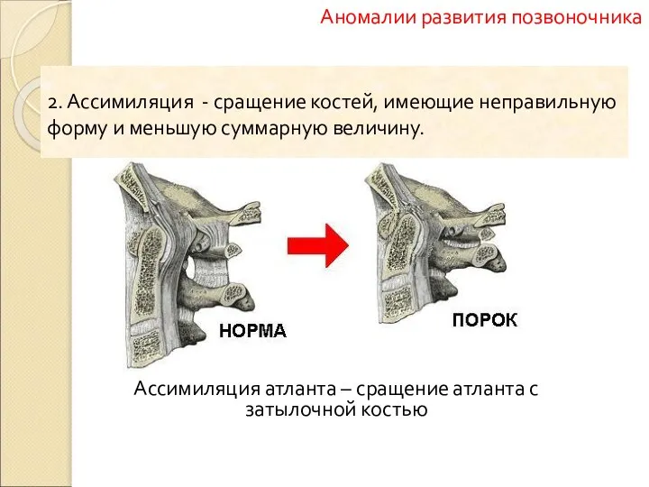 Ассимиляция атланта – сращение атланта с затылочной костью Аномалии развития позвоночника