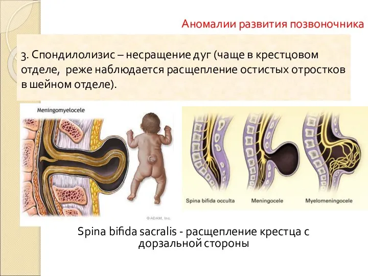 Spina bifida sacralis - расщепление крестца с дорзальной стороны Аномалии развития