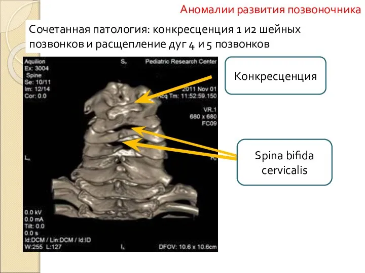 Сочетанная патология: конкресценция 1 и2 шейных позвонков и расщепление дуг 4