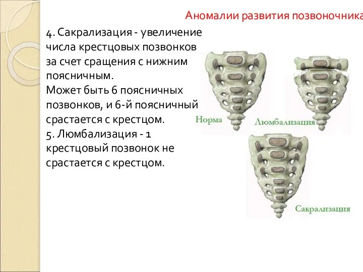 Аномалии развития позвоночника 4. Сакрализация - увеличение числа крестцовых позвонков за