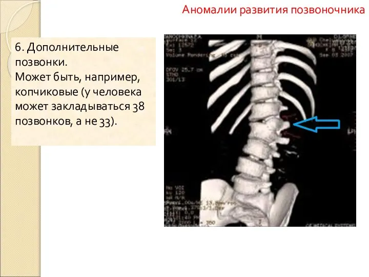 6. Дополнительные позвонки. Может быть, например, копчиковые (у человека может закладываться