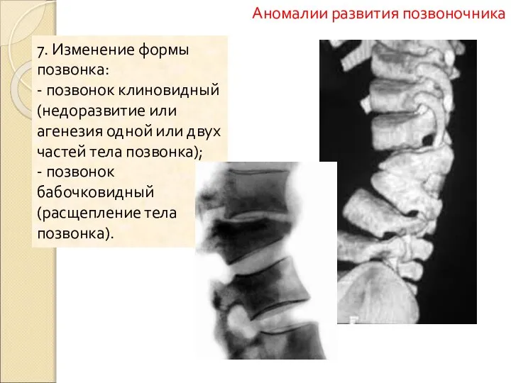 7. Изменение формы позвонка: - позвонок клиновидный (недоразвитие или агенезия одной