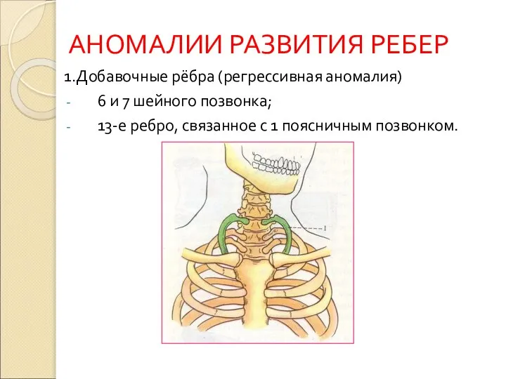 АНОМАЛИИ РАЗВИТИЯ РЕБЕР 1.Добавочные рёбра (регрессивная аномалия) 6 и 7 шейного