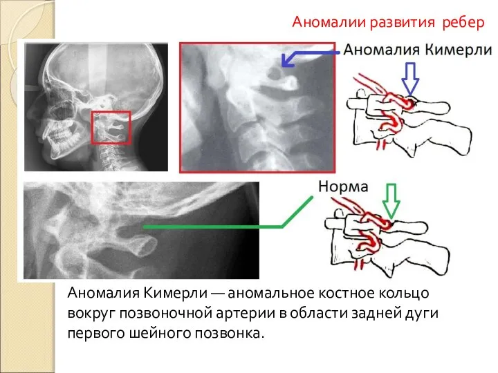 Аномалия Кимерли — аномальное костное кольцо вокруг позвоночной артерии в области