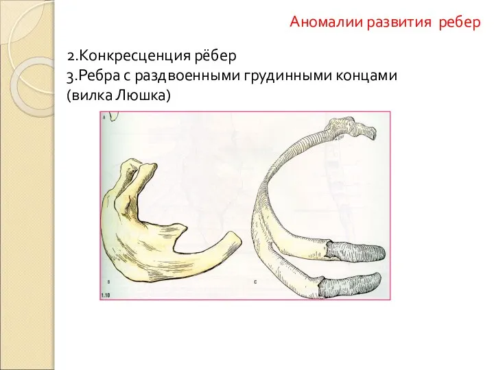 2.Конкресценция рёбер 3.Ребра с раздвоенными грудинными концами (вилка Люшка) Аномалии развития ребер