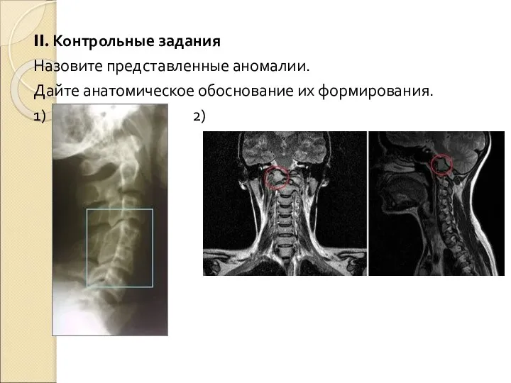 II. Контрольные задания Назовите представленные аномалии. Дайте анатомическое обоснование их формирования. 1) 2)