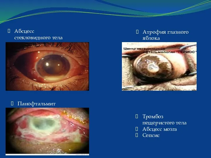 Абсцесс стекловидного тела Панофтальмит Атрофия глазного яблока Тромбоз пещеристого тела Абсцесс мозга Сепсис