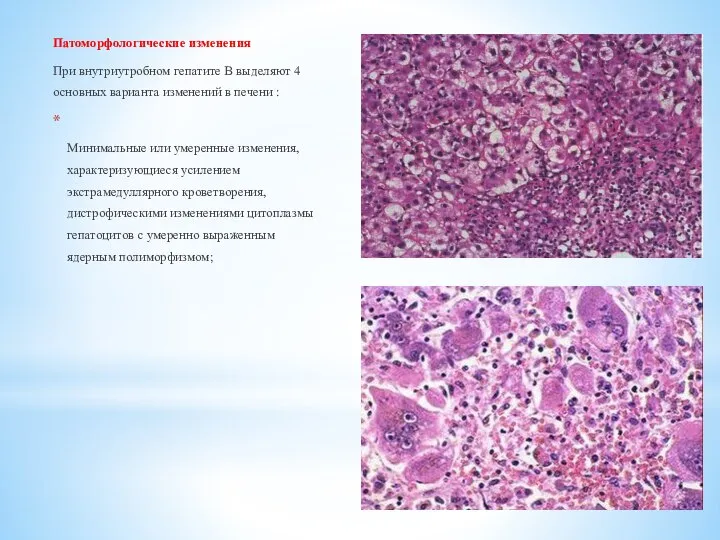 Патоморфологические изменения При внутриутробном гепатите В выделяют 4 основных варианта изменений