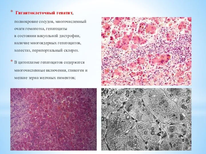 Гигантоклеточный гепатит, полнокровие сосудов, многочисленный очаги гемопоэза, гепатоциты в состоянии вакуольной