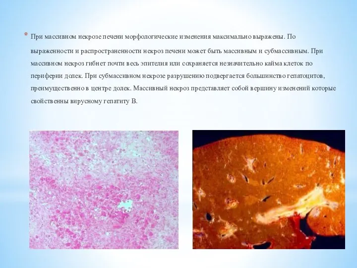 При массивном некрозе печени морфологические изменения максимально выражены. По выраженности и