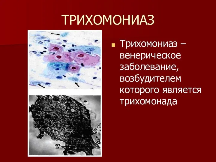 ТРИХОМОНИАЗ Трихомониаз – венерическое заболевание, возбудителем которого является трихомонада