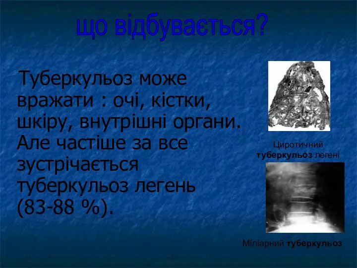 Туберкульоз може вражати : очі, кістки, шкіру, внутрішні органи. Але частіше