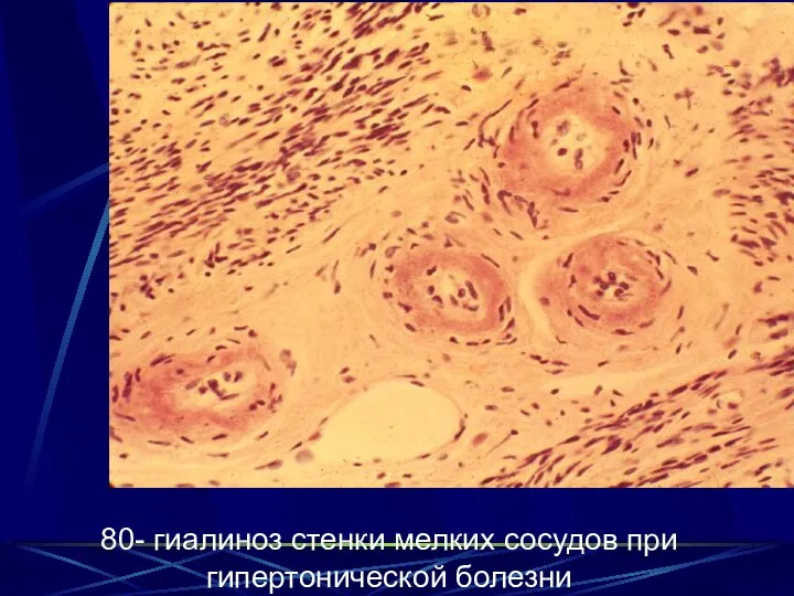 80- гиалиноз стенки мелких сосудов при гипертонической болезни 80- гиалиноз стенки мелких сосудов при гипертонической болезни