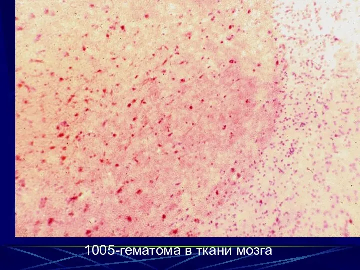 1005-гематома в ткани мозга 1005-гематома в ткани мозга