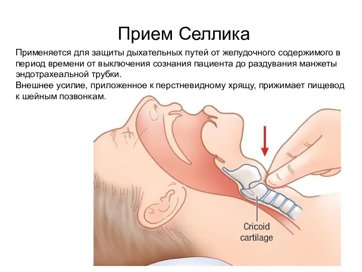 Прием Селлика Применяется для защиты дыхательных путей от желудочного содержимого в