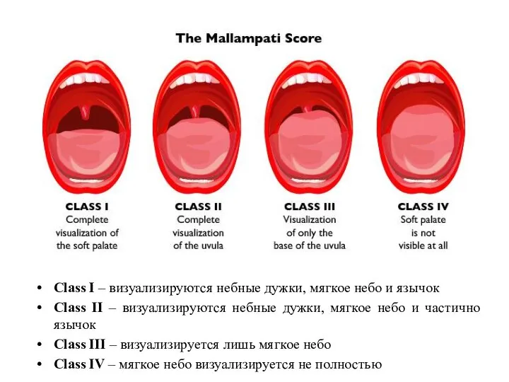 Class I – визуализируются небные дужки, мягкое небо и язычок Class