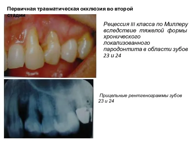 Рецессия III класса по Миллеру вследствие тяжелой формы хронического локализованного пародонтита
