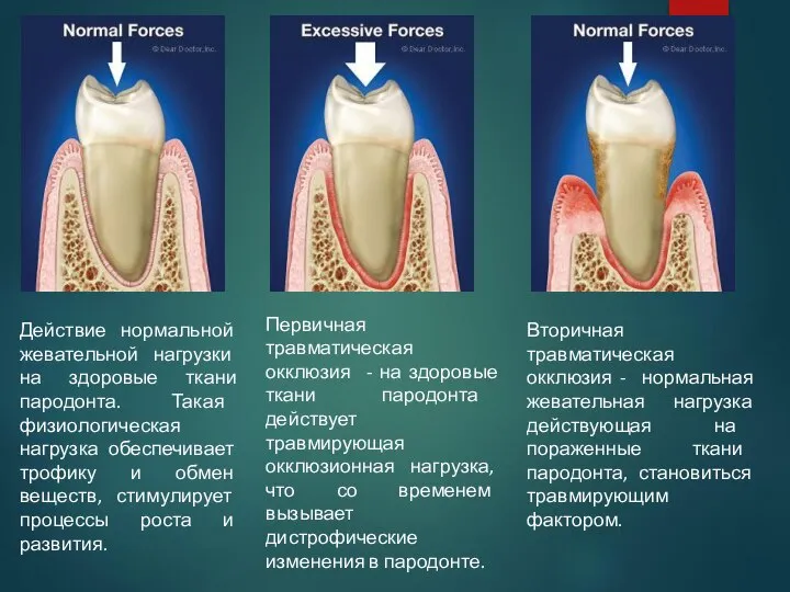 Действие нормальной жевательной нагрузки на здоровые ткани пародонта. Такая физиологическая нагрузка