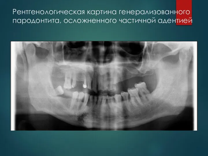 Рентгенологическая картина генерализованного пародонтита, осложненного частичной адентией