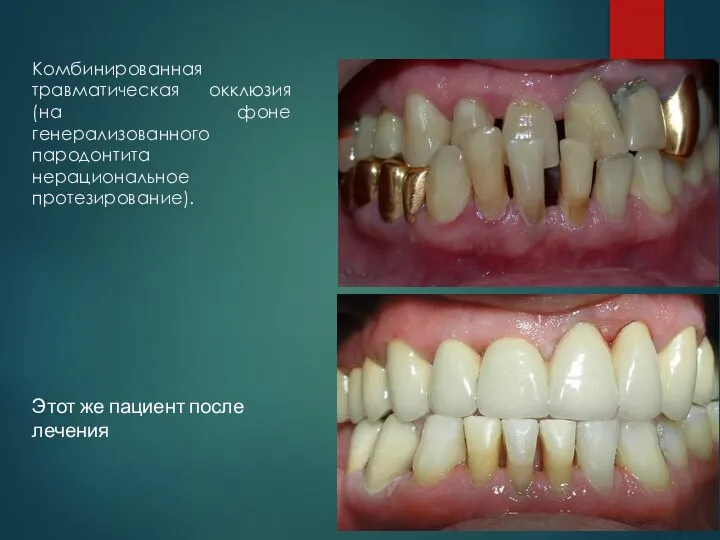 Комбинированная травматическая окклюзия (на фоне генерализованного пародонтита нерациональное протезирование). Этот же пациент после лечения