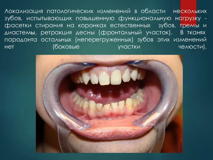 Локализация патологических изменений в области нескольких зубов, испытывающих повышенную функциональную нагрузку