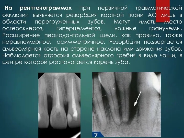 -На рентгенограммах при первичной травматической окклюзии выявляется резорбция костной ткани АО