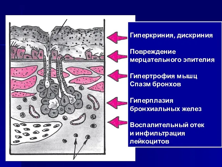 Гиперкриния, дискриния Повреждение мерцательного эпителия Гипертрофия мышц Спазм бронхов Гиперплазия бронхиальных