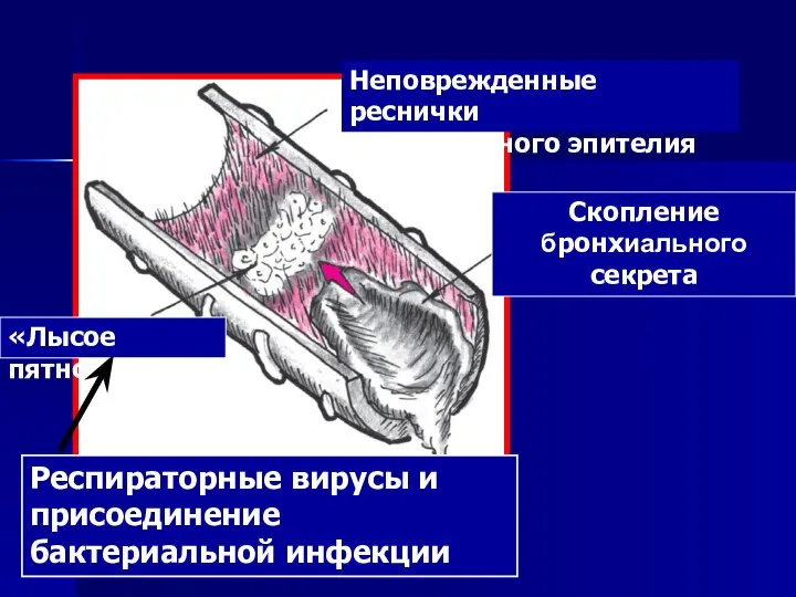 Неповрежденные реснички мерцательного эпителия «Лысое пятно» Скопление бронхиального секрета Респираторные вирусы и присоединение бактериальной инфекции