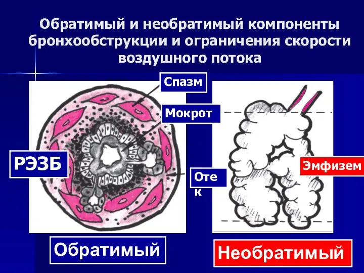 Обратимый и необратимый компоненты бронхообструкции и ограничения скорости воздушного потока Обратимый