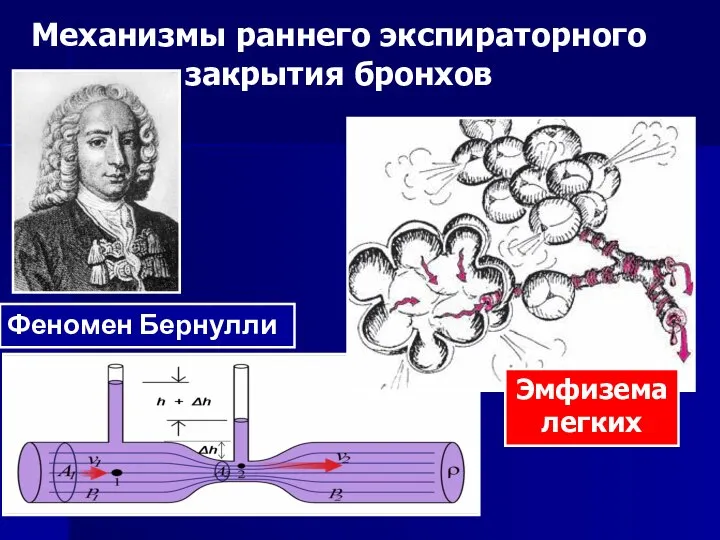 Феномен Бернулли Эмфизема легких Механизмы раннего экспираторного закрытия бронхов