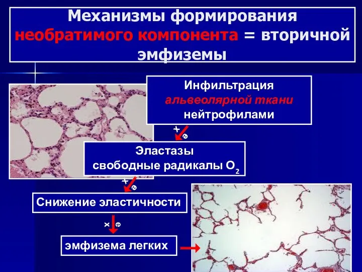 Механизмы формирования необратимого компонента = вторичной эмфиземы е х Инфильтрация альвеолярной