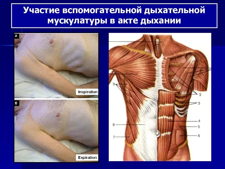 Участие вспомогательной дыхательной мускулатуры в акте дыхании