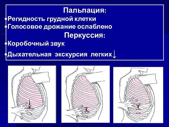 Пальпация: Регидность грудной клетки Голосовое дрожание ослаблено Перкуссия: Коробочный звук Дыхательная экскурсия легких↓